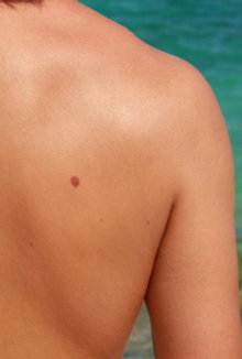 Moles on back.