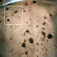 Melanoma.