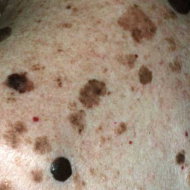 Melanoma.