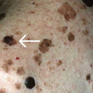 Melanoma.