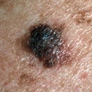 Melanoma.