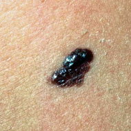 Melanoma.