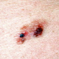 Melanoma.