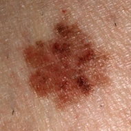Melanoma.