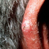 Squamous cell carcinoma.